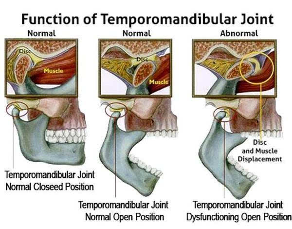 恼人的颞下颌关节功能紊乱