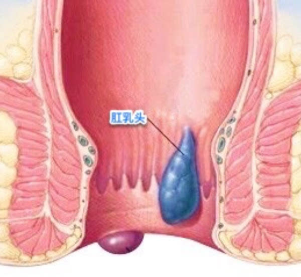 肛乳头增生后期,称为肛乳头瘤,多是良性肿瘤,是肛管上皮组织增生.