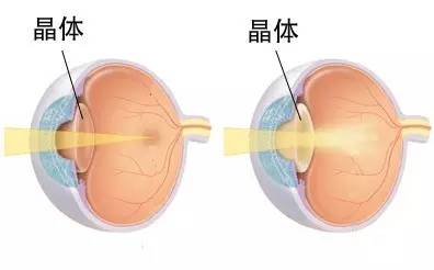 白内障是眼科的常见病多发病,通俗地讲就是眼内的晶状体发生了变性