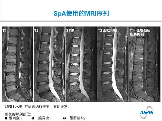 这是一份正常脊柱的mri影像,椎骨密度均一,与椎间盘间隔均匀.