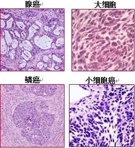 癌症该如何分类?从1.0到4.0版