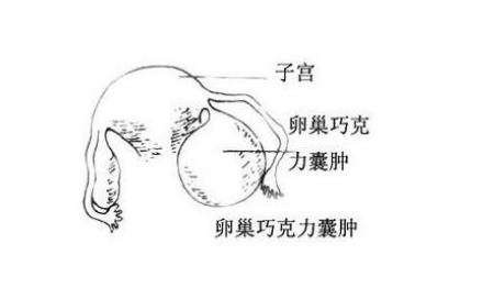 协和医院彭澎和您谈谈巧囊术后8问