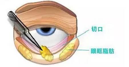 卢丙仑教授:什么是内眦赘皮?如何治疗?