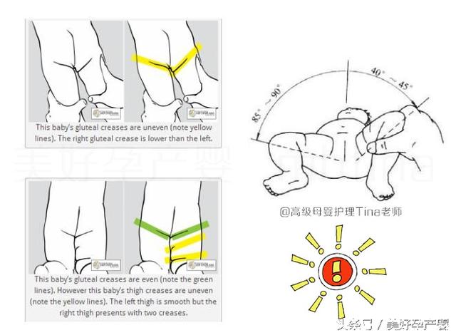 被忽视的宝宝髋关节脱臼,1岁以后发现就晚了!