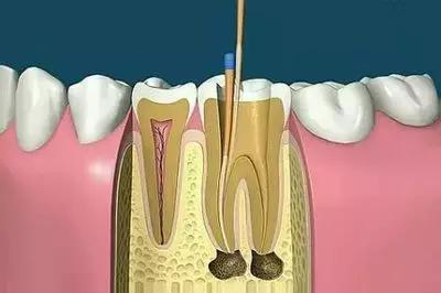 蛀牙太深,牙神经坏了,该怎么治?