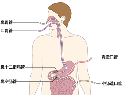 肠内营养支持