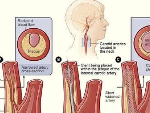颈动脉彩超可有效避免脑中风