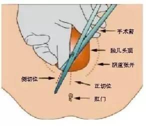 【准妈妈】好害怕,顺产就一定要侧切吗?