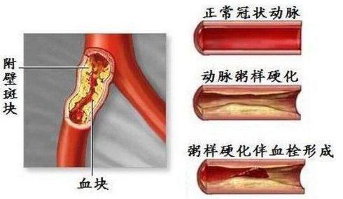 颈动脉彩超可有效避免脑中风