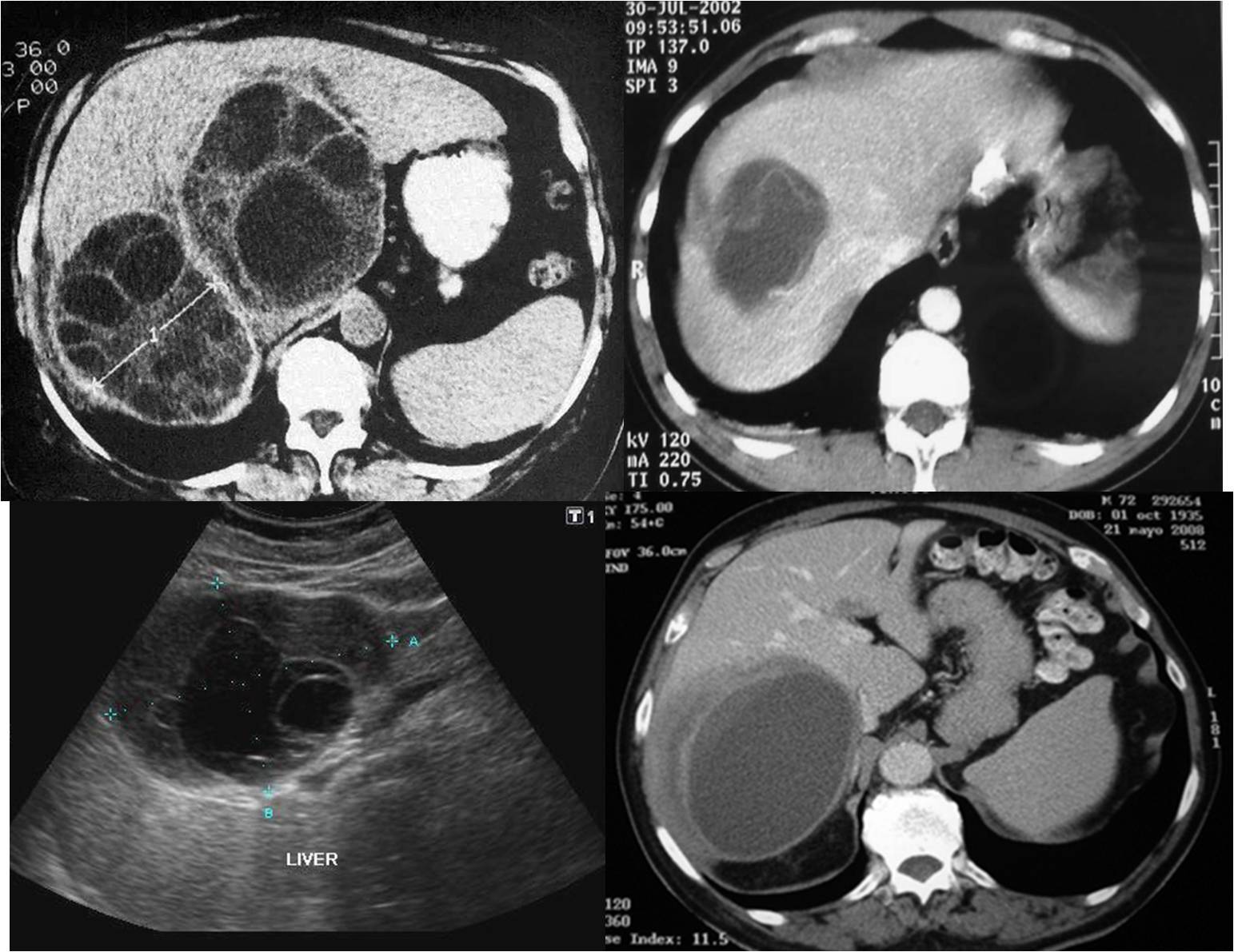三、PET/CT-MR增强异机融合在原发性肝癌诊断中的使用价值|上海大学附属上海全景云医学影像诊断中心|全景医学影像