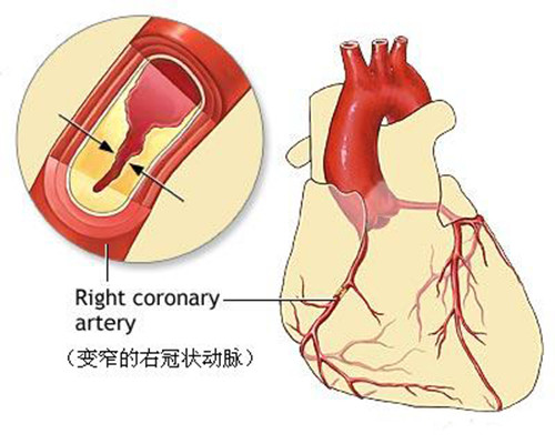 主动脉硬化、心肌缺血是否需要做冠状动脉造影