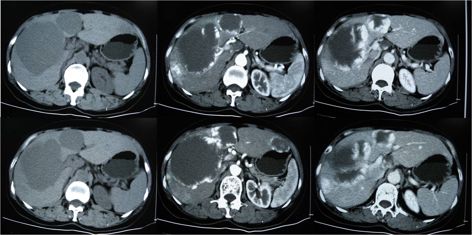 E诊断:肝脏部位CT诊断笔记
