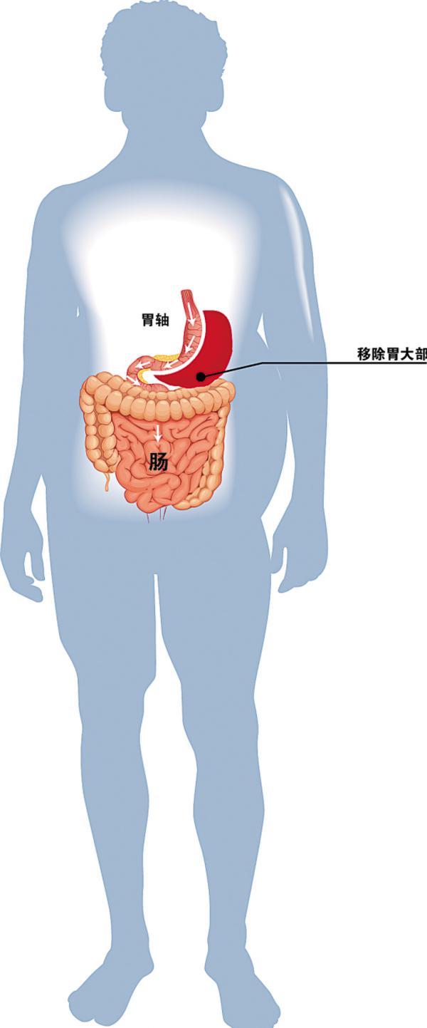 代谢综合征的诊断标准