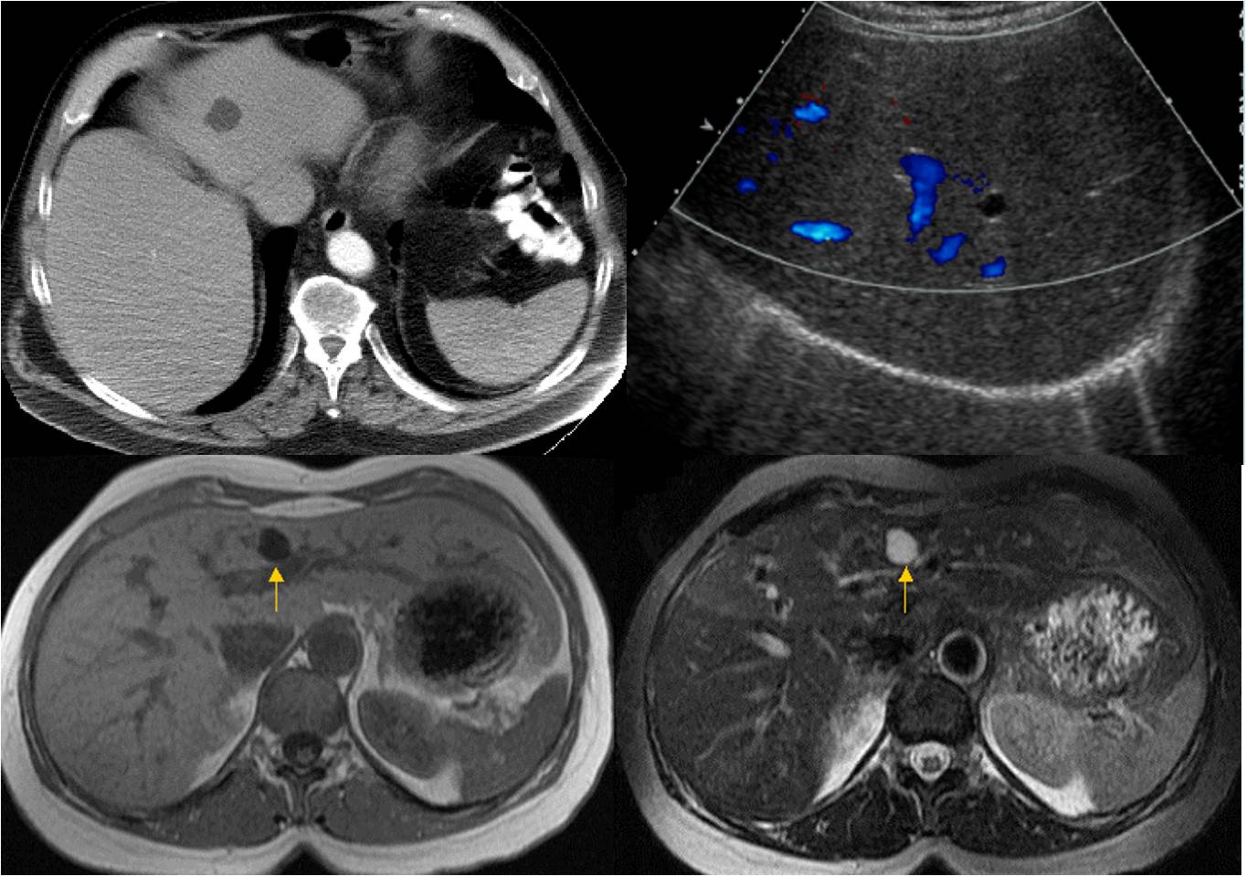 E诊断:肝脏部位CT诊断笔记