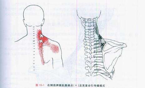 易于损伤的肩胛提肌