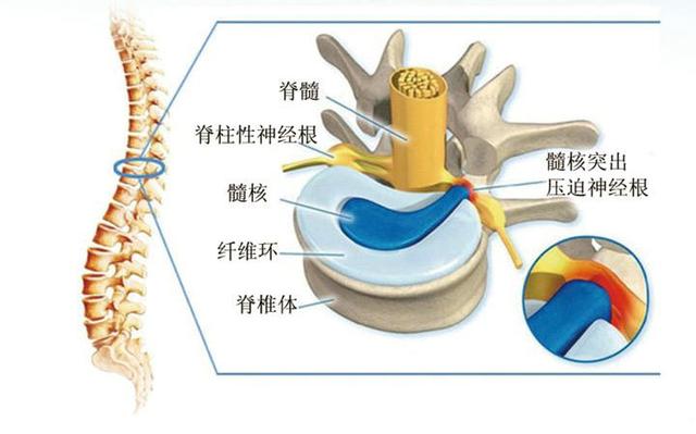 腰痛聊聊腰椎间盘突出症