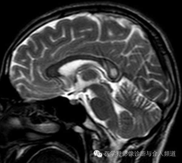 矢状面 t2wi 显示胼胝体压部信号异常,但不累及胼胝体其他部位.