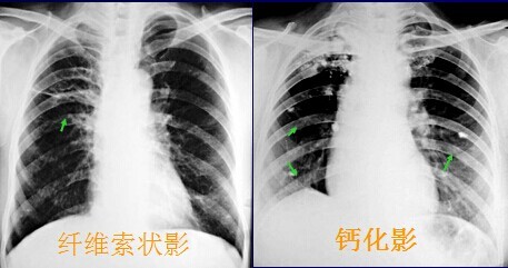 通常发生于退变或坏死组织内,可见于肺,淋巴结干酪性结核灶,肺错构瘤