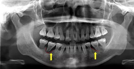 下面这张x光片是比较典型的牙周炎的x光片,该患者全口所有的牙齿都