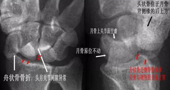 头骨与桡骨距离变近,头骨,钩骨与月骨部分重叠,月骨形态及位置基本