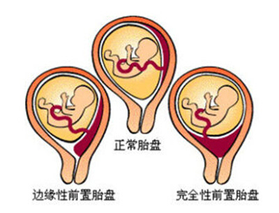 完全性前置胎盘手术记录