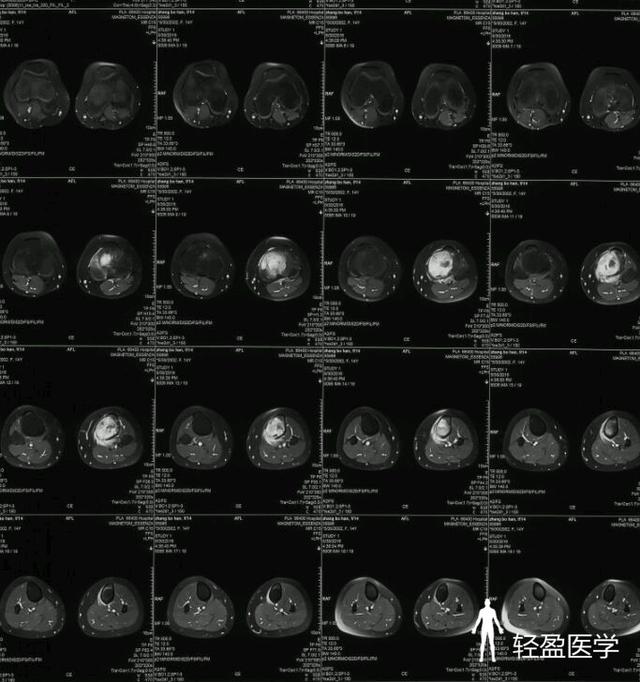 女13岁左膝部疼痛3个月余