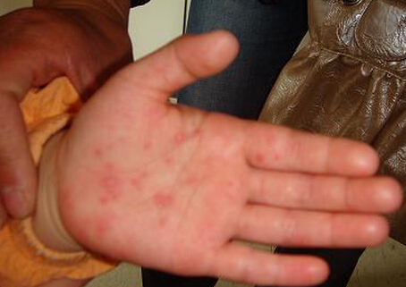 手足口病疱疹怎么治十种方法摆脱该症状