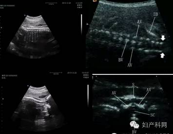 孕囊靠近宫颈口怎么办