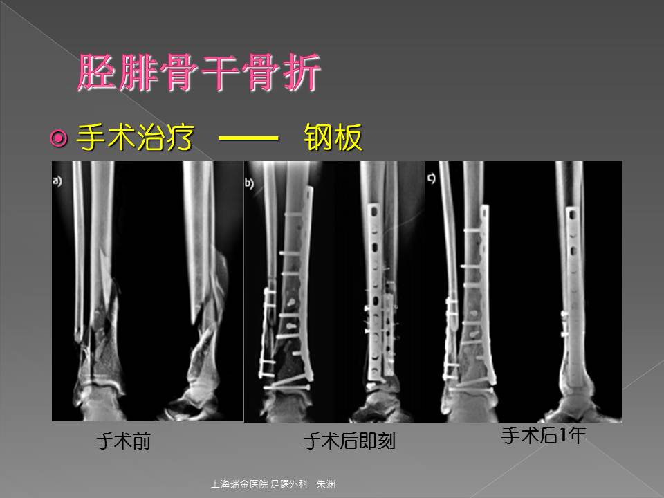 胫腓骨干骨折的手术治疗——外固定支架