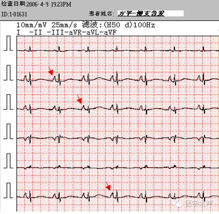 正常窦性心律时,每个 qrs波前均有一个p波,p波在i,ii,avf,v4-v6导联