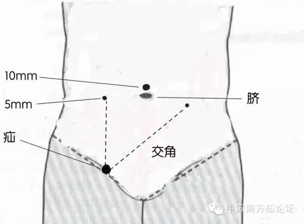 精品|七步详解腔镜腹股沟疝修补术(上)