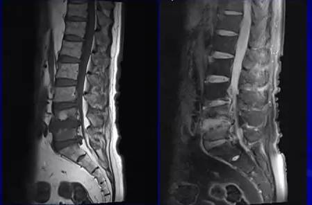 l4-5椎体骨质破坏,l3-s1椎间盘突出,椎管狭窄 双手正位片