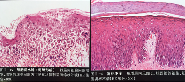 而湿疹的病理是海绵水肿和角化不全,所以原发的湿疹出现脓疱的情况极