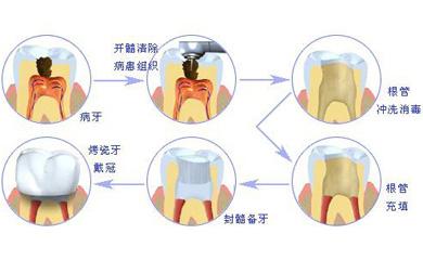 根管治疗术治疗急性牙髓炎--广州德伦口腔