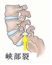 3,腰椎峡部裂   腰椎峡部不连所致,患椎关节突压痛.