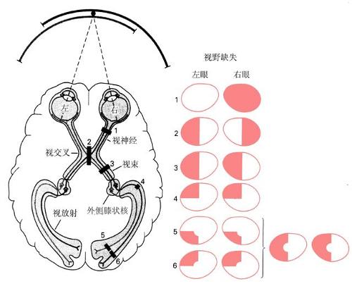 贺晓生教授视野缺损及视觉物倾斜小心脑瘤