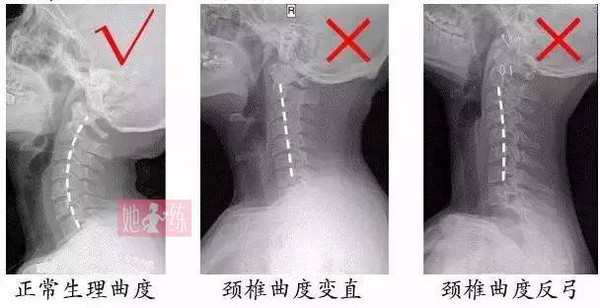 女孩低头玩手机,抬头时咔哒一声颈椎折了!