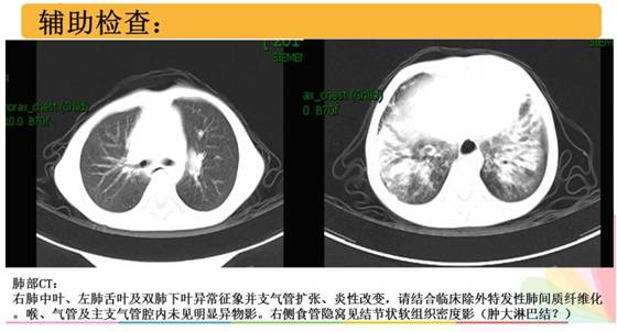 病例讨论丨食道闭锁与气管食管瘘