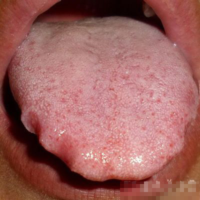 说明气血不足;如果舌头上出现斑点,瘀点,就是瘀血;如果舌乳头明显增大