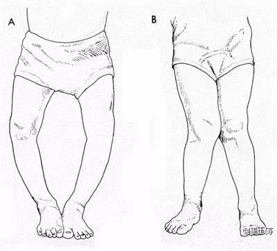 宝宝有点x型腿怎么办