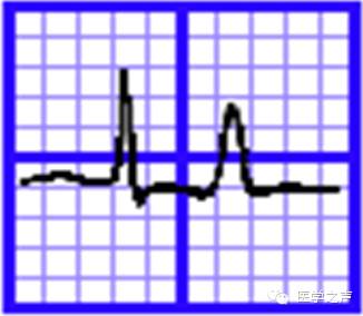 每天学看一份心电图(第6期)
