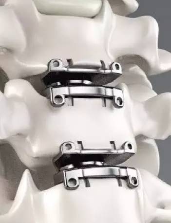 前沿科技prestigelp颈椎人工间盘置换术