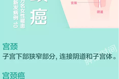 一图读懂:宫颈癌