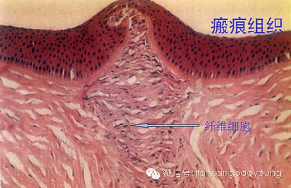 点阵激光?瘢痕组织的"整容师"