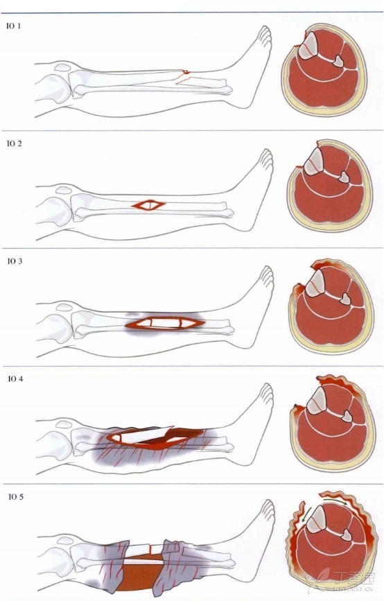 伴有骨折的软组织损伤 这 2 种分型系统不可不知