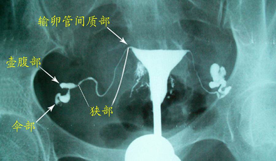 输卵管不通是先通水还是先造影?