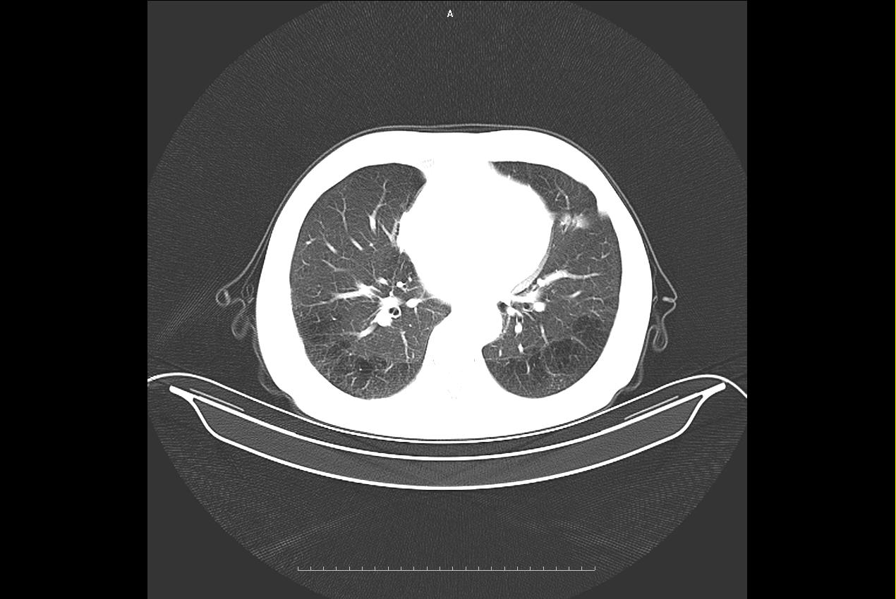 弥漫性肺疾病，高分辨CT让你无所遁形！