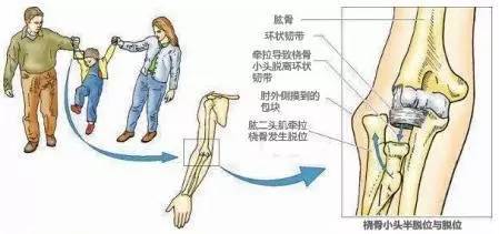 家长必读丨只是牵了一下手孩子手肘就脱臼了家长们警惕