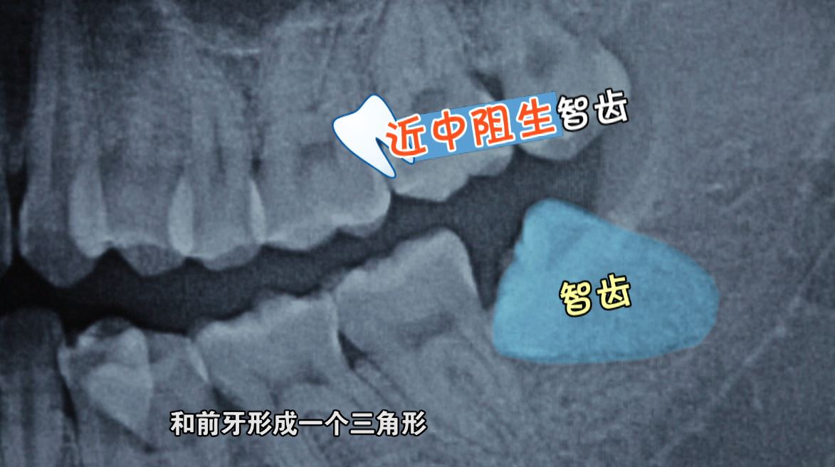 小心引发牙源性肿瘤!