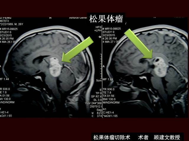 罕见脑内巨大松果体瘤切除术